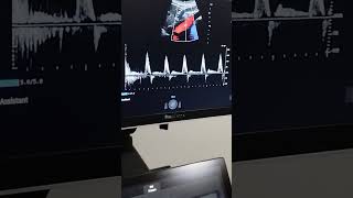 PRACTICA ECO DOPPLER ABDOMINAL [upl. by Geoffrey]