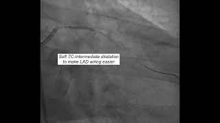 Trifurcation LM lesion treated with a singlestent PCI [upl. by Gnak]