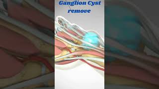 Ganglion Cyst remove viral ganglioncystbiology3danimation crazypharmaguruji1331 [upl. by Rbma661]