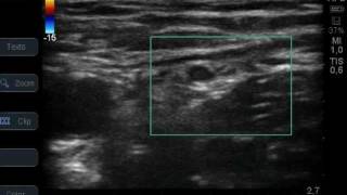 US Lateral circumflex femoral artery [upl. by Kathryne]