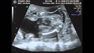 Live Ultrasound at 18 weeks 3 days pregnant with baby number two [upl. by Maribeth]