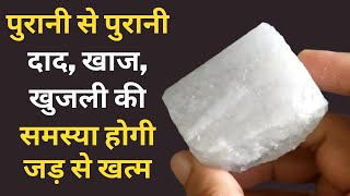 दाद खाज खुजली को जड़ से खत्म करने का 100 घरेलू उपाय  Natural way to get rid of itching  Khujli [upl. by Klepac]