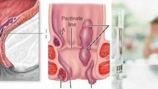 External Hemorrhoids Treatment [upl. by Winona95]