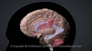 Intracerebral Hemorrhage Stroke [upl. by Reivaz860]