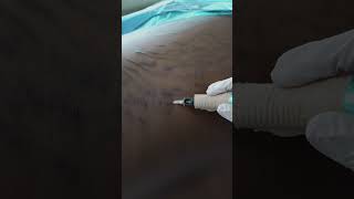 Stretch Marks Inkless Removal Boleyn Treatment Los Angeles 🌍 shorts [upl. by Underwood430]