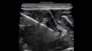 Ulnar nerve block in the forearm ultrasound guided [upl. by Analaj]