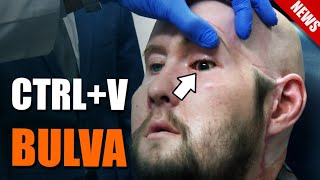 Došlo na první úspěšnou transplantaci oční bulvy – Vědátornews [upl. by Ecnarretal]