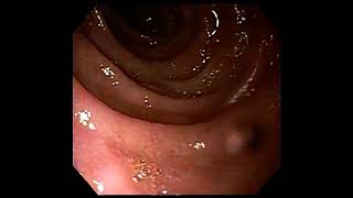 Reflux oesophagitis [upl. by Anuala]