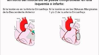 Electrocardiograma 2 Topografía de las Lesiones Coronarias [upl. by Amity]