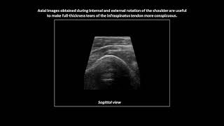 Fullthickness tear of the infraspinatus tendon on shoulder ultrasound [upl. by Hyams633]