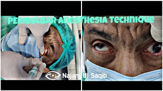 Peribulbar Anesthesia Technique How To Achieve Adequate Akinesia For Ocular Surgery [upl. by Anaele]