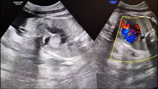 Intracardiac Tumor in fetus during pregnancy 37 weeks Rhabdomyoma [upl. by Adnohsar65]