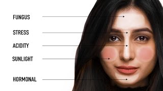 What Your Pimples Say About Your Health  Face Mapping with Dermatologist Bindu Sthalekar [upl. by Tennos]