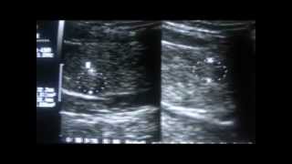 THYROID COLLOIDAL CYST or PARATHYROID GLAND HYPERPLASIA  part 1b [upl. by Scott]