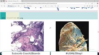 Chp13 Robbins Patho  Lung Pathology  Coal Worker Pneumoconiosis  Restrictive Lung Disorders [upl. by Affay268]