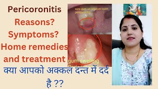 pericoronitisCausesSymptomsHome remedies and treatment [upl. by Hoo683]