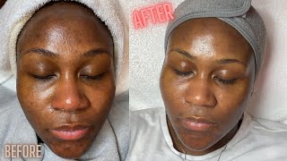 Hyperpigmentation Correction w Microdermabrasion [upl. by Yasmeen]