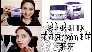 Mederma PM Cream Review  Mederma Cream  Mederma for Scars  Remove your Scars  Womens World [upl. by Sukcirdor]