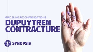 Dupuytrens Contracture Guideline  SYNOPSIS [upl. by Therese]