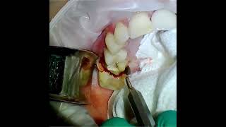 A twoforone dental extraction The last tooth shows a valsalva to test for a sinus communication [upl. by Iman158]