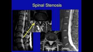 UCSF Radiology Spinal Stenosis [upl. by Moffat]