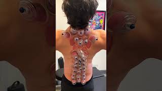 How the Cupping Therapy Works😲 Explained [upl. by Annohs]