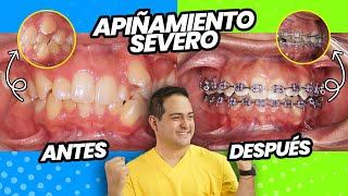 ORTODONCIA CASO REAL con SEVERO APIÑAMIENTO RESUELTO CON BRACKETS ❤️ [upl. by Lyret612]