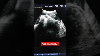 Anencephaly with brain dangling behind in the amniotic fluid anomalyscan [upl. by Nagad]