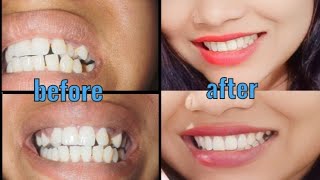 before and after braces journey [upl. by Richards]