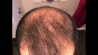 5 months using minoxidil  Rogaine 5 Before amp After results [upl. by Conger]