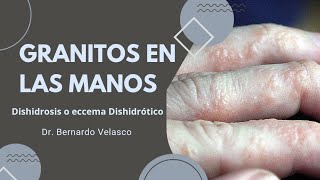 GRANITOS EN LAS MANOS PRURITO Vejiguitas en los dedos DISHIDROSIS O ECCEMA DISHIDRÓTICO 🖐 [upl. by Audrey]