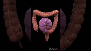 Understanding Colon Volvulus A Twist in the Digestive Tale [upl. by Erialcyram177]