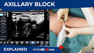 Ultrasound Guided Axillary Brachial Plexus Block NYSORA Regional Anesthesia [upl. by Naida]