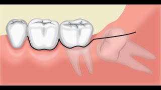 Auto Transplantation – A Viable Option of Saving Teeth [upl. by Naillij]