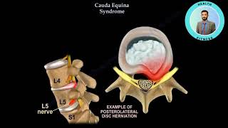 Cauda Equina Syndrom [upl. by Alleen]