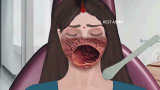 ASMR Animation treatment from infected mouth  2D Animation restasmr1 [upl. by Emyam]