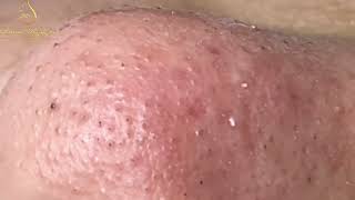 Loan Nguyen Acne Treatment 1431h [upl. by Britton150]