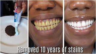 in two minutes remove 10 years of stains from teeth Results will Shock You [upl. by Nimar16]