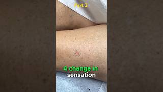 Symptoms and prevention of skin cancer Part 2 health cancer shorts fypシ゚viral skincancer fyp [upl. by Otir]