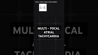 multifocal atrial tachycardia  ECG basics [upl. by Weinman]