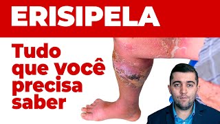 Erispela como curar sinais e sintomas e como prevenir suas complicações Guia completo da doença [upl. by Kim]