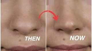 Effective Massage to SLIM YOUR NOSE RESHAPE IT and SHARPEN IT  LETS MAKE OUR NOSE SMALLER [upl. by Eednac]