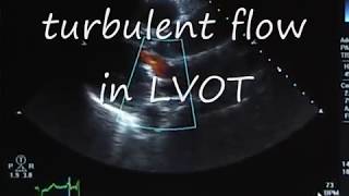 Systolic Anterior MotionSAM following Mitral Valve Prolapse Repair [upl. by Yrogiarc318]