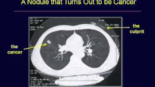 GRACEcast041LungCancerScreening Workup amp FollowUp [upl. by Tessa]