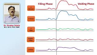 Urodynamic study of voiding phase of bladder [upl. by Enilamme536]