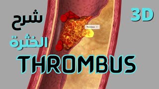 Thrombus formation amp occlusion of vessel 3D explanation  تكوين الخثرة والانسداد الأوعية [upl. by Melosa]