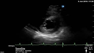 Chapter 7  Hyperdynamic left ventricle PSAX view [upl. by Doone]