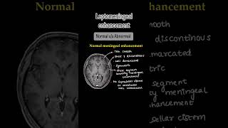 Leptomeningeal enhancement Full video on our channelXrayusg mri brain neuroimaging neetpg [upl. by Ongineb]