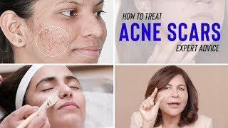 Treatments for ACNE SCARS  Dr Bindus Expert Advice [upl. by Eilac152]