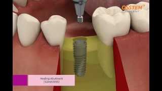 OSSTEM IMPLANT TSIII System Surgical Procedure Taper Kit and Straight Drill Kit [upl. by Wymore]